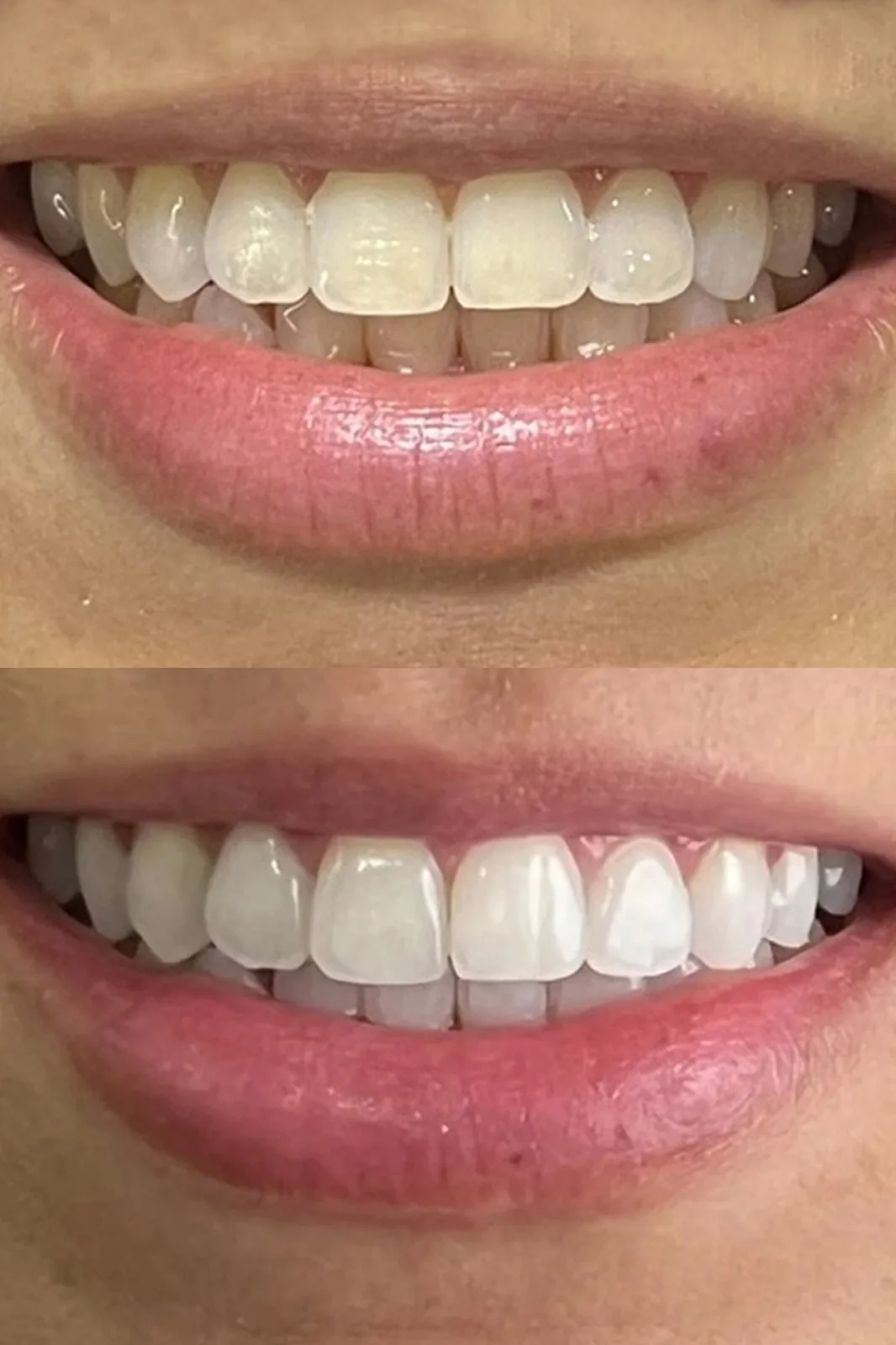 Antes: Clareamento e estética do sorriso