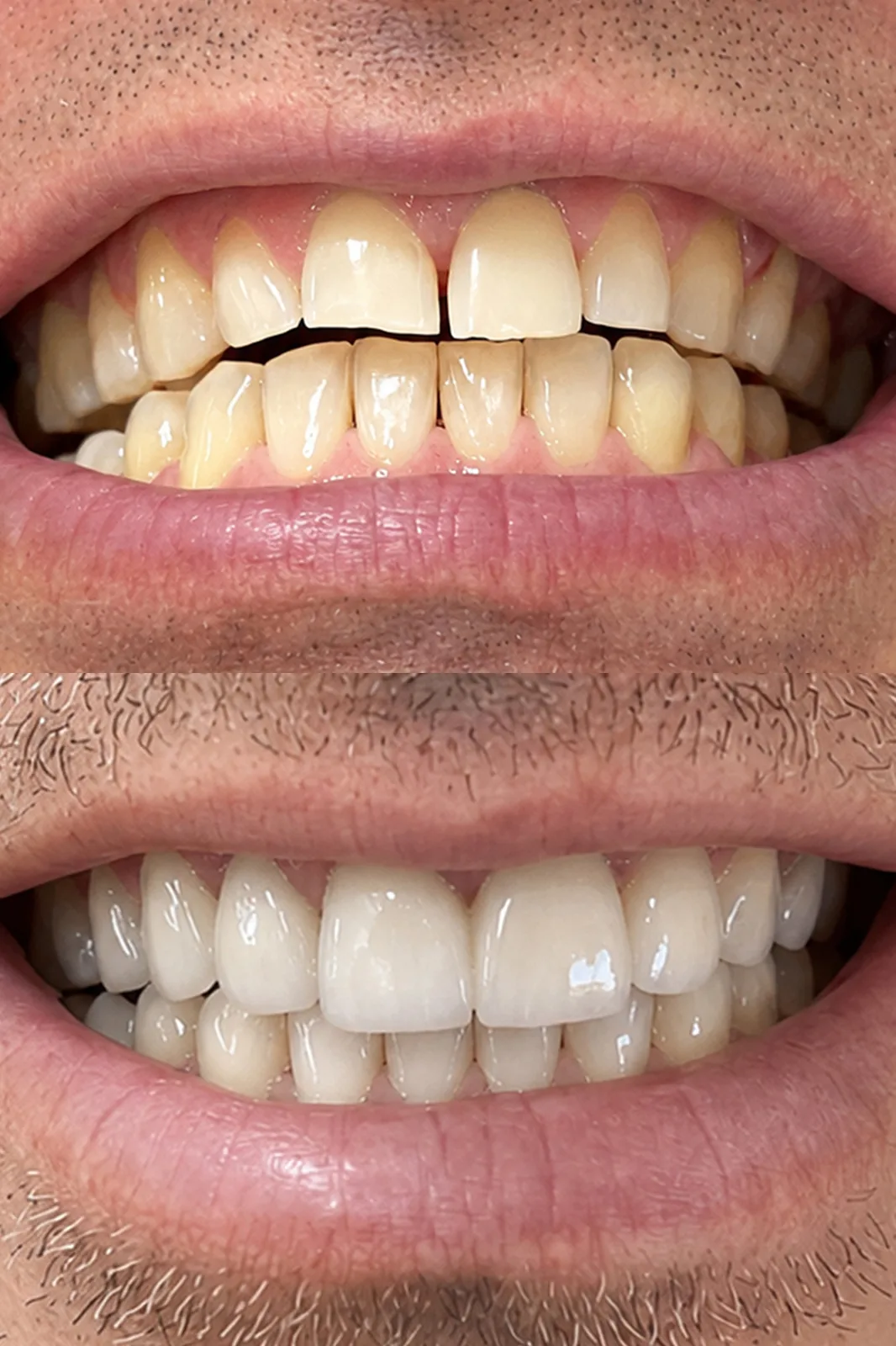 Antes: Reabilitação estética com facetas