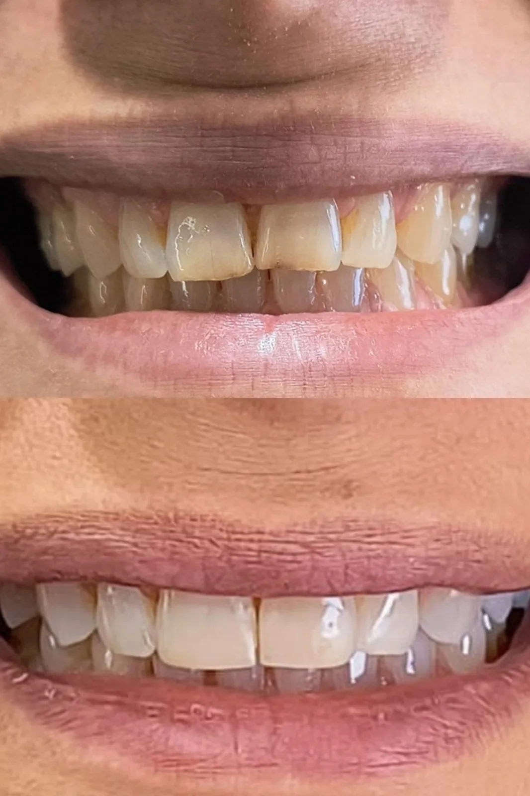 Antes: Restaurações e estética anterior