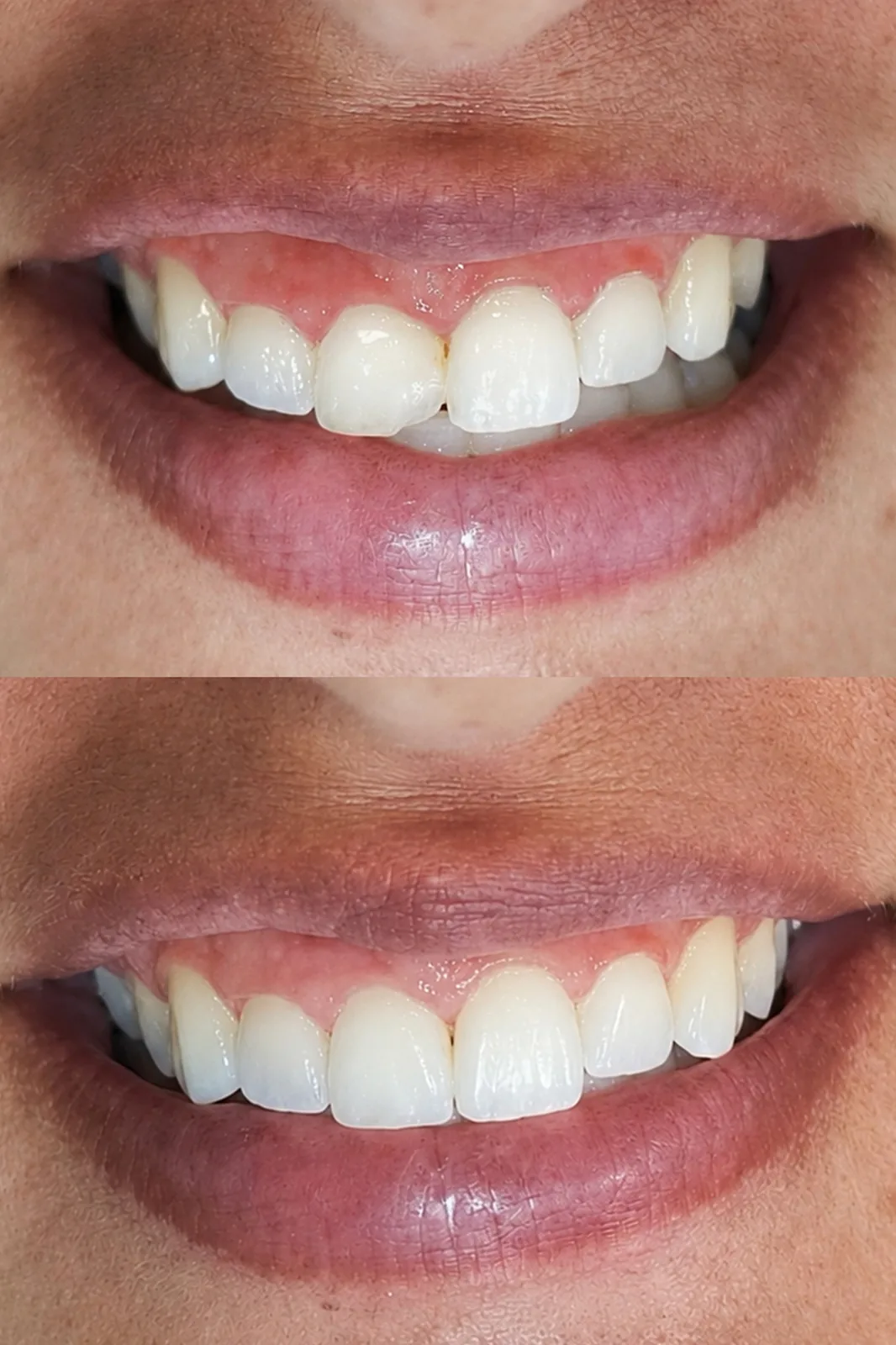 Antes: Harmonização gengival e facetas