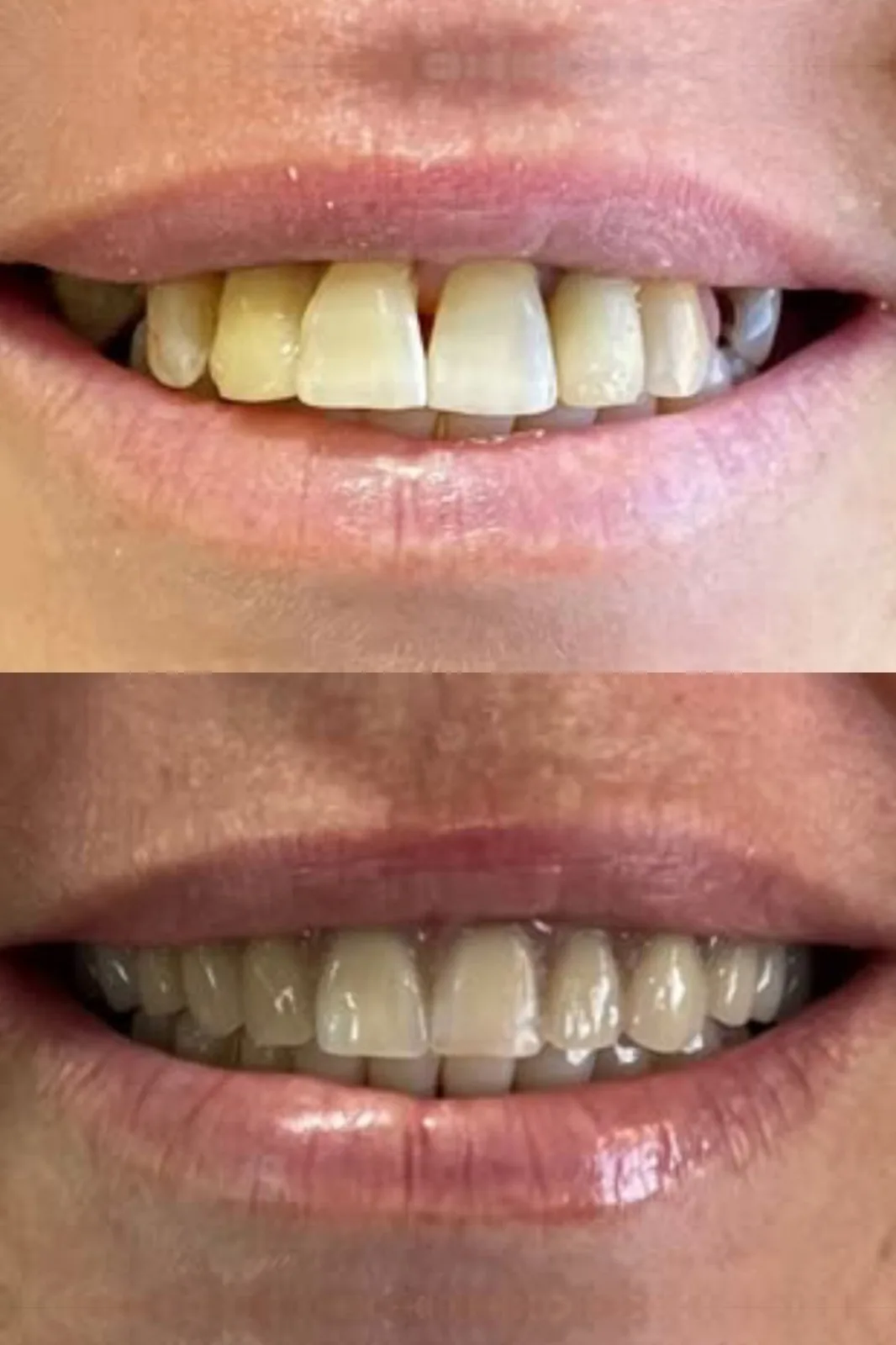 Antes: Estética do sorriso com facetas